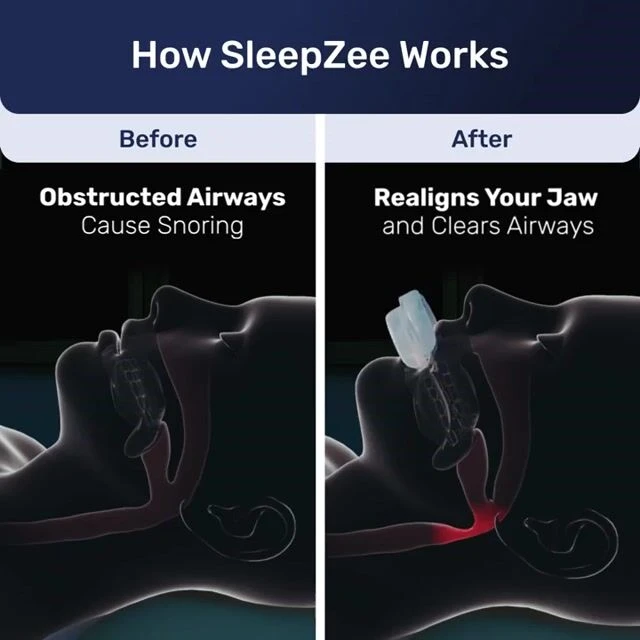 Zquiet Anti Snoring Mouthpiece image